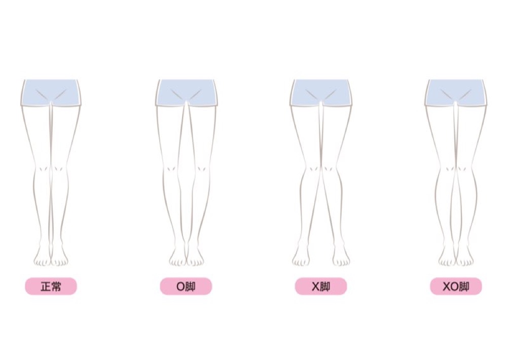 脚の形のタイプ(正常・O脚・X脚・XO脚)